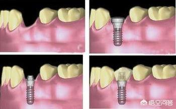口腔种植牙流程是怎样的