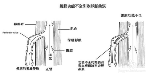 动脉曲张是什么