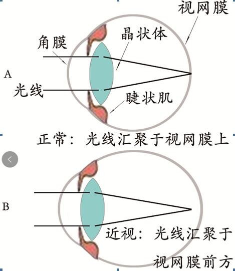 如何让视力恢复正常呢？