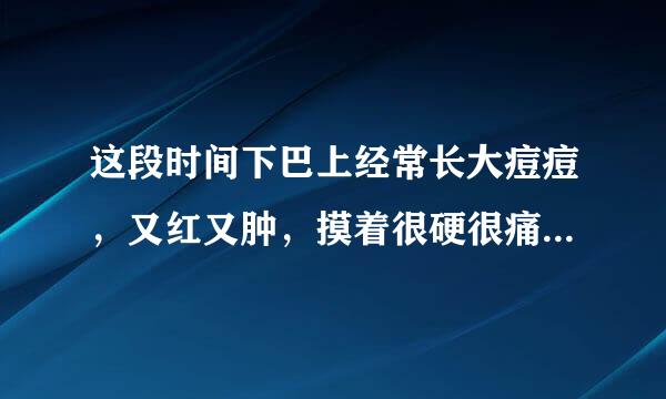 这段时间下巴上经常长大痘痘，又红又肿，摸着很硬很痛，这是怎么回事？