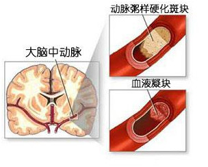 轻度脑梗塞如何治疗