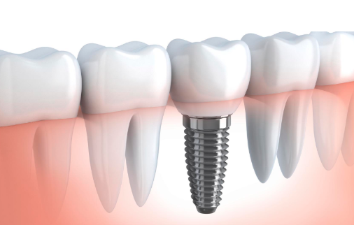 种植牙的利与弊？