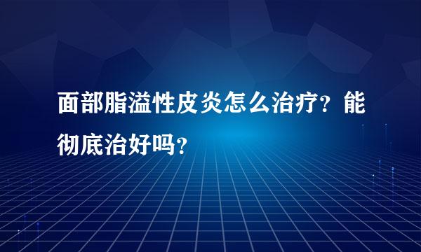 面部脂溢性皮炎怎么治疗？能彻底治好吗？