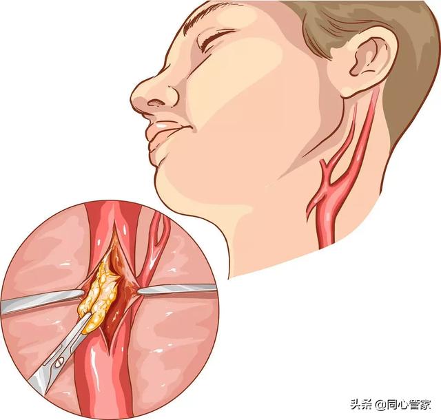 颈动脉出现斑块怎么去除