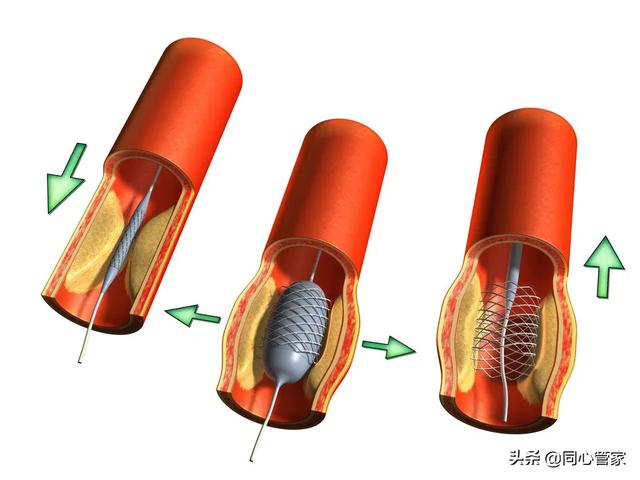 颈动脉出现斑块怎么去除