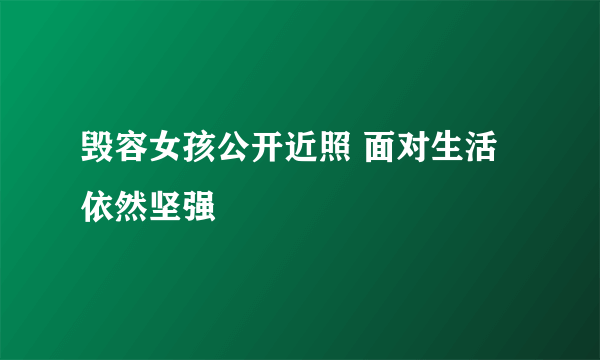 毁容女孩公开近照 面对生活依然坚强