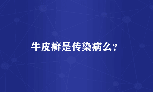 牛皮癣是传染病么？