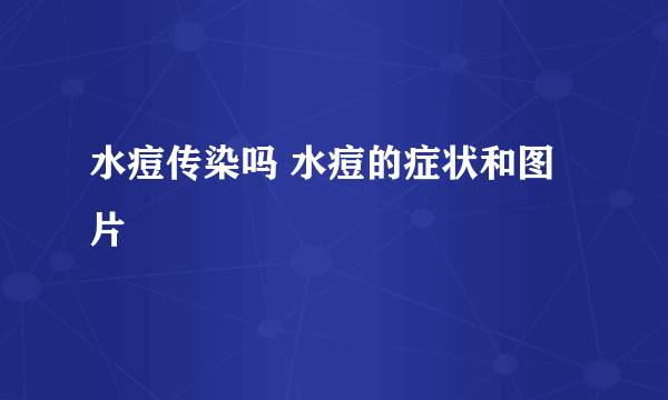 水痘传染吗 水痘的症状和图片